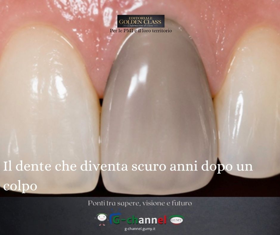 Il dente che diventa scuro anni dopo un colpo